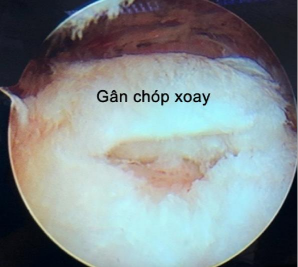 Hình 4 7 Ảnh minh hoạ rách bán phần 50 bề dày Nguồn ảnh chụp trong mổ của BN 4