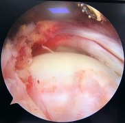 Hình 4 8 Ảnh minh hoạ rách chữ L chữ U và hình ảnh khâu khép rìa gân rách bằng 2