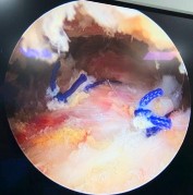 Hình 4 8 Ảnh minh hoạ rách chữ L chữ U và hình ảnh khâu khép rìa gân rách bằng 3