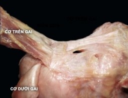 Hình 1 9 Nhìn từ phía sau của khớp vai Bờ sau của diện bám gân trên gai bị bờ 1