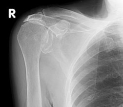 Hình 1 20 X quang khớp vai tư thế trước sau trong rách lớn CX thấy chỏm xương 2