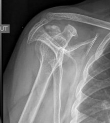 Hình 1 21 Minh họa calci hóa gân CX khớp vai nhìn trên tư thế Lamy Nguồn Theo nguồn 3