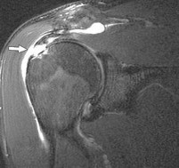  Siêu âm Hình 1 22 Rách hoàn toàn gân cơ trên gai 51 Có độ nhạy và độ đặc 4