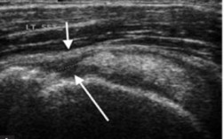 Hình 1 23 Hình minh họa trên siêu âm mũi tên màu trắng cho thấy hình ảnh rách 5