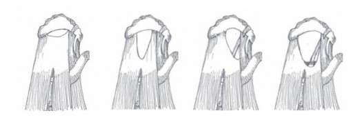 Hình 1 24 Các hình dạng rách hoàn toàn CX53 Theo mức độ co r t gân Theo phân 6