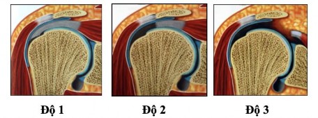 Hình 1 25 Phân loại Patte về mức độ co rút gân54 Theo kích thước của Cofield 7