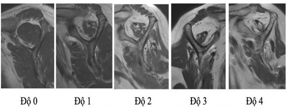 Hình 1 26 Mức độ thoái hóa mỡ trong cơ theo Goutallier 56 1 4 ĐIỀU TRỊ RÁCH CHÓP 8