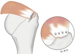 Hình 1 30 Minh họa kỹ thuật khâu một hàng66 Có 4 kiểu khâu thông dụng trong 4