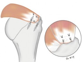 Hình 1 33 Hình minh hoạ kỹ thuật khâu hai hàng sau khi hoàn thành66 Trong phương 7