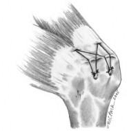 Hình 1 34 Kỹ thuật khâu bắc cầu dùng với 4 cầu nối chỉ và 2 cầu nối chỉ 8