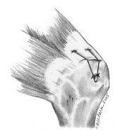 Hình 1 34 Kỹ thuật khâu bắc cầu dùng với 4 cầu nối chỉ và 2 cầu nối chỉ 9