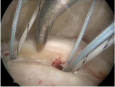 Hình 1 35 Kỹ thuật tạo vi tổn thương theo Milano25 Taniguchi và cs năm 2015 cũng mô 1