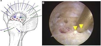 Hình 1 36 Kỹ thuật tạo vi tổn thương theo Taniguchi mũi tên màu vàng chỉ giọt 2