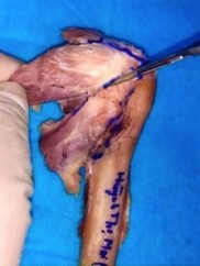 Hình 2 3 Phẫu tích dọc theo bờ gân Nguồn Ảnh phẫu tích trong nghiên cứu 2