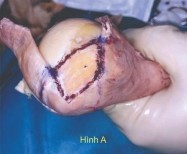 Hình 2 4 A cắt bỏ thân gân tại vị trí diện bám B Đánh dấu diện bám của 3