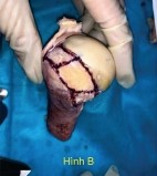 Hình 2 4 A cắt bỏ thân gân tại vị trí diện bám B Đánh dấu diện bám của 4