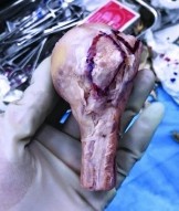 Hình 2 5 Diện bám gân dưới vai sau khi cắt bỏ thân gân tại vị trí diện bám 5