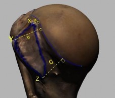 Hình 2 9 Minh hoạ các mốc của diện bám gân dưới vai và KC đến bờ sụn khớp 7