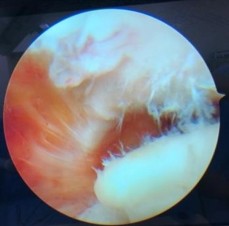 Hình 2 17 Tình trạng viêm túi hoạt dịch dưới MCV và xước điểm bám của dây 14