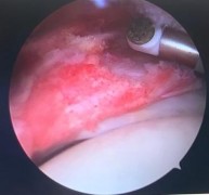 Hình 2 18 Đốt tổ chức viêm trong khoang dưới MCV Nguồn ảnh chụp trong mổ của 15