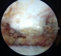 Hình 2 19 Bộc lộ chồi xương ở góc trước ngoài MCV mài tạo hình khoang dưới 16