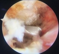 Hình 2 19 Bộc lộ chồi xương ở góc trước ngoài MCV mài tạo hình khoang dưới 17