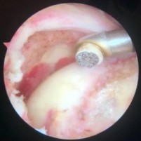 Hình 2 20 Sau mài bộc lộ diện bám của gân Nguồn ảnh chụp trong mổ của BN Lê 18