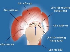 Hình 2 22 Hình minh hoạ cách tạo lỗ vi tổn thương theo hàng phía trong vị trí 22
