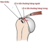 Hình 2 22 Hình minh hoạ cách tạo lỗ vi tổn thương theo hàng phía trong vị trí 23