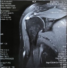 Hình phụ lục 1A Phim CHT bệnh nhân trước mổ cho thấy rách nhỏ gân trên gai 3