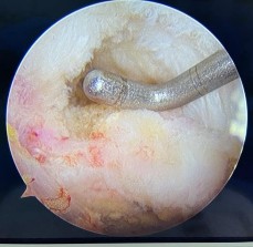 Hình phụ lục 1B Hình ảnh rách nhỏ gân trên gai Nguồn BN nghiên cứu Hình phụ 4