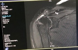 Hình phụ lục 1B Kết quả liền gân trên siêu âm và sau mổ Nguồn BN nghiên cứu 7