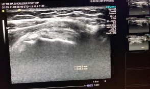 Hình phụ lục 1B Kết quả liền gân trên siêu âm và sau mổ Nguồn BN nghiên cứu 8