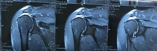 Hình phụ lục 2A Phim CHT bệnh nhân trước mổ cho thấy rách lớn và co rút gân 1