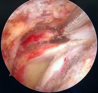 Hình phụ lục 3B Hình ảnh rách rất rộng khoảng gian chóp xoay gân trên gai dưới 10