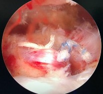 Hình phụ lục 3B Hình ảnh rách rất rộng khoảng gian chóp xoay gân trên gai dưới 11