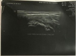 Hình phụ lục 3C Kết quả trên siêu âm và CHT sau mổ thấy gân chóp xoay rách 12