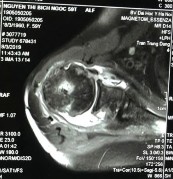 Hình phụ lục 3C Kết quả trên siêu âm và CHT sau mổ thấy gân chóp xoay rách 13