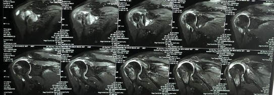 Hình phụ lục 3C Kết quả trên siêu âm và CHT sau mổ thấy gân chóp xoay rách 14