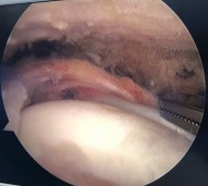 Hình phụ lục 2B Hình ảnh rách rất rộng gân trên gai dưới gai khoảng gian chóp 2