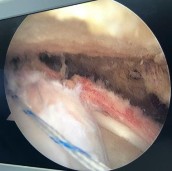 Hình phụ lục 2B Hình ảnh rách rất rộng gân trên gai dưới gai khoảng gian chóp 3