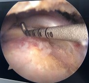 Hình phụ lục 2C Hình ảnh xác định vị trí đặt 02 neo Nguồn BN nghiên cứu 4