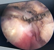 Hình phụ lục 2C Hình ảnh xác định vị trí đặt 02 neo Nguồn BN nghiên cứu 5