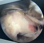 Hình phụ lục 2C Hình ảnh xác định vị trí đặt 02 neo Nguồn BN nghiên cứu 6