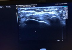 Hình phụ lục 2D Hình ảnh liền gân độ 1 trên Siêu Âm và độ 2 trên CHT khi 7