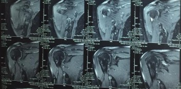 Hình phụ lục 2D Hình ảnh liền gân độ 1 trên Siêu Âm và độ 2 trên CHT khi 8