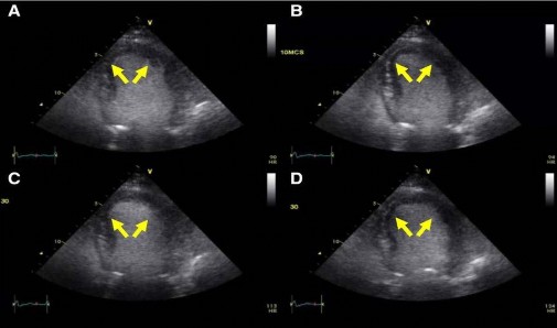 Hình 1 1 Siêu âm tim gắng sức với dobutamine có chất tương phản Hình ảnh cuối 1
