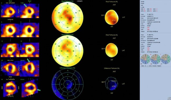 Hình 1 3 Kết quả SPECT với 201 Tl thì nghỉ tĩnh và thì tái phân bố sau 24 giờ 6