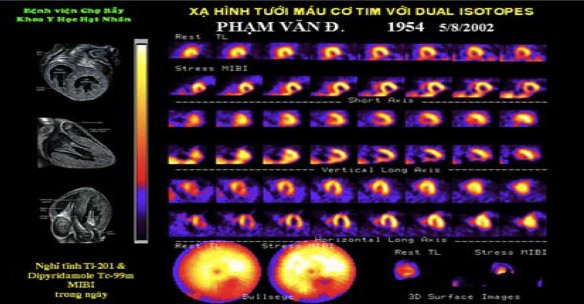 Hình 1 4 Xạ hình tưới máu cơ tim kết hợp 2 đồng vị nghỉ tĩnh với 201Tl và 1