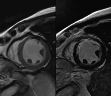 Hình 1 6 Kết quả MRI tim của một bệnh nhân có nhồi máu thành trước mạn tính 3
